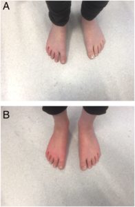 neuropathy withdrawal pssd